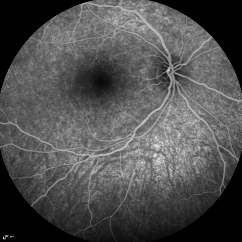 Acute Annular Outer Retinopathy for 3 Months - 25 YO Female  Late FA
25-year-old female who, about three months ago, put on her sunglasses and noticed a smudge in the vision and at that point she noticed the right eye was hazy. She had a cold a week or two before the vision loss, but she didnâ€™t have any fever.  She has no focal neurological problems in her past history.  VA 20/20 OU
