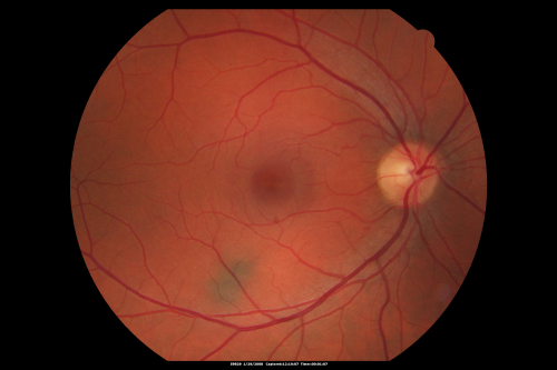 Acute Zonal Occult Outer Retinopathy
45-year-old man  noticed a few years ago peripheral vision blurriness in the left eye and also some central vision loss.   Previous to that, as far as he knows, the two eyes were okay. 

VISUAL ACUITY:  OD:  20/20;  OS:  20/40.  
Keywords: azoor;acute zonal occult outer retinopathy;retinitis pigmentosa