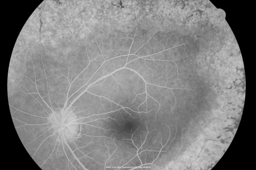 Acute Zonal Occult Outer Retinopathy
45-year-old man  noticed a few years ago peripheral vision blurriness in the left eye and also some central vision loss.   Previous to that, as far as he knows, the two eyes were okay. 

VISUAL ACUITY:  OD:  20/20;  OS:  20/40.  
Keywords: azoor;acute zonal occult outer retinopathy;retinitis pigmentosa