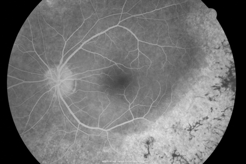 Acute Zonal Occult Outer Retinopathy
45-year-old man  noticed a few years ago peripheral vision blurriness in the left eye and also some central vision loss.   Previous to that, as far as he knows, the two eyes were okay. 

VISUAL ACUITY:  OD:  20/20;  OS:  20/40.  
Keywords: azoor;acute zonal occult outer retinopathy;retinitis pigmentosa