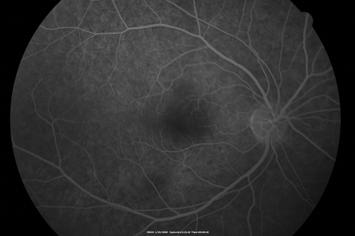 Acute Zonal Occult Outer Retinopathy
45-year-old man  noticed a few years ago peripheral vision blurriness in the left eye and also some central vision loss.   Previous to that, as far as he knows, the two eyes were okay. 

VISUAL ACUITY:  OD:  20/20;  OS:  20/40.  
Keywords: azoor;acute zonal occult outer retinopathy;retinitis pigmentosa