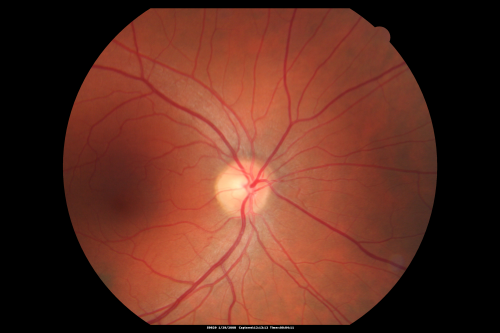 Acute Zonal Occult Outer Retinopathy
45-year-old man  noticed a few years ago peripheral vision blurriness in the left eye and also some central vision loss.   Previous to that, as far as he knows, the two eyes were okay. 

VISUAL ACUITY:  OD:  20/20;  OS:  20/40.  
Keywords: azoor;acute zonal occult outer retinopathy;retinitis pigmentosa