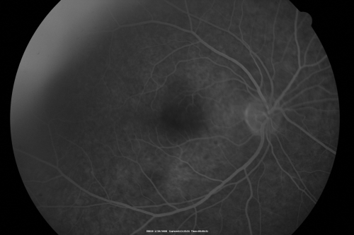Acute Zonal Occult Outer Retinopathy
45-year-old man  noticed a few years ago peripheral vision blurriness in the left eye and also some central vision loss.   Previous to that, as far as he knows, the two eyes were okay. 

VISUAL ACUITY:  OD:  20/20;  OS:  20/40.  
Keywords: azoor;acute zonal occult outer retinopathy;retinitis pigmentosa