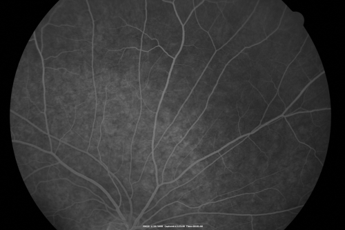 Acute Zonal Occult Outer Retinopathy
45-year-old man  noticed a few years ago peripheral vision blurriness in the left eye and also some central vision loss.   Previous to that, as far as he knows, the two eyes were okay. 

VISUAL ACUITY:  OD:  20/20;  OS:  20/40.  
Keywords: azoor;acute zonal occult outer retinopathy;retinitis pigmentosa