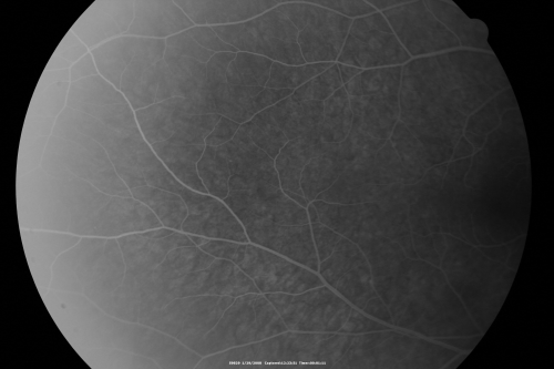 Acute Zonal Occult Outer Retinopathy
45-year-old man  noticed a few years ago peripheral vision blurriness in the left eye and also some central vision loss.   Previous to that, as far as he knows, the two eyes were okay. 

VISUAL ACUITY:  OD:  20/20;  OS:  20/40.  
Schlüsselwörter: azoor;acute zonal occult outer retinopathy;retinitis pigmentosa