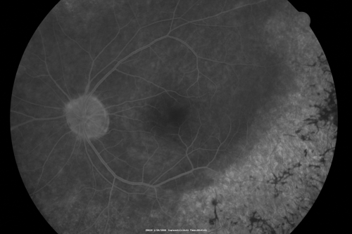 Acute Zonal Occult Outer Retinopathy
45-year-old man  noticed a few years ago peripheral vision blurriness in the left eye and also some central vision loss.   Previous to that, as far as he knows, the two eyes were okay. 

VISUAL ACUITY:  OD:  20/20;  OS:  20/40.  
Keywords: azoor;acute zonal occult outer retinopathy;retinitis pigmentosa
