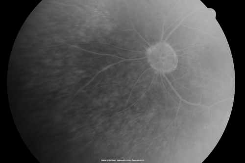 Acute Zonal Occult Outer Retinopathy
45-year-old man  noticed a few years ago peripheral vision blurriness in the left eye and also some central vision loss.   Previous to that, as far as he knows, the two eyes were okay. 

VISUAL ACUITY:  OD:  20/20;  OS:  20/40.  
Keywords: azoor;acute zonal occult outer retinopathy;retinitis pigmentosa
