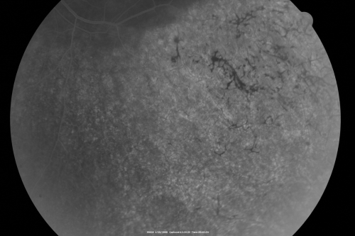 Acute Zonal Occult Outer Retinopathy
45-year-old man  noticed a few years ago peripheral vision blurriness in the left eye and also some central vision loss.   Previous to that, as far as he knows, the two eyes were okay. 

VISUAL ACUITY:  OD:  20/20;  OS:  20/40.  
Keywords: azoor;acute zonal occult outer retinopathy;retinitis pigmentosa