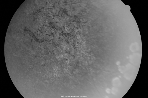 Acute Zonal Occult Outer Retinopathy
45-year-old man  noticed a few years ago peripheral vision blurriness in the left eye and also some central vision loss.   Previous to that, as far as he knows, the two eyes were okay. 

VISUAL ACUITY:  OD:  20/20;  OS:  20/40.  
Keywords: azoor;acute zonal occult outer retinopathy;retinitis pigmentosa