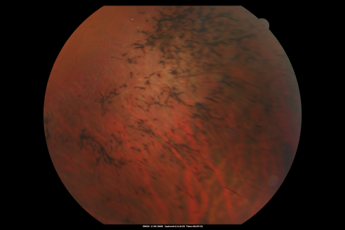 Acute Zonal Occult Outer Retinopathy
45-year-old man  noticed a few years ago peripheral vision blurriness in the left eye and also some central vision loss.   Previous to that, as far as he knows, the two eyes were okay. 

VISUAL ACUITY:  OD:  20/20;  OS:  20/40.  
Keywords: azoor;acute zonal occult outer retinopathy;retinitis pigmentosa