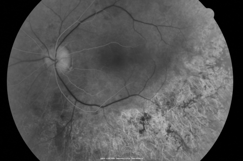 Acute Zonal Occult Outer Retinopathy
45-year-old man  noticed a few years ago peripheral vision blurriness in the left eye and also some central vision loss.   Previous to that, as far as he knows, the two eyes were okay. 

VISUAL ACUITY:  OD:  20/20;  OS:  20/40.  
Keywords: azoor;acute zonal occult outer retinopathy;retinitis pigmentosa