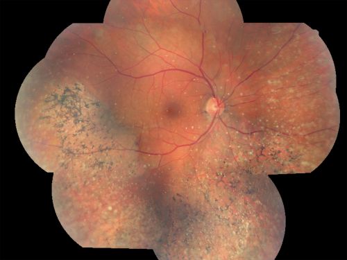 Psuedo-retinitis Pigmentosa - Bone Spicules One Eye - Probably Acute Zonal Occult Outer Retinopathy (AZOOR)
65-year-old woman has pseudoretinitis pigmentosa in the right eye only, most likely from acute zonal occult outer retinopathy.   OD 20/25,  OS 20/25
