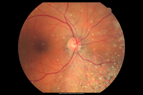 Psuedo-retinitis Pigmentosa - Bone Spicules One Eye - Probably Acute Zonal Occult Outer Retinopathy (AZOOR)
65-year-old woman has pseudoretinitis pigmentosa in the right eye only, most likely from acute zonal occult outer retinopathy.   OD 20/25,  OS 20/25
