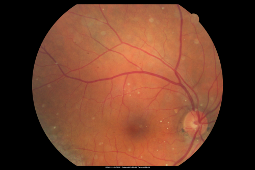 Psuedo-retinitis Pigmentosa - Bone Spicules One Eye - Probably Acute Zonal Occult Outer Retinopathy (AZOOR)
65-year-old woman has pseudoretinitis pigmentosa in the right eye only, most likely from acute zonal occult outer retinopathy.   OD 20/25,  OS 20/25

