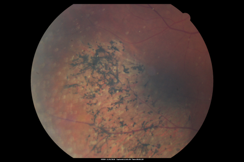 Psuedo-retinitis Pigmentosa - Bone Spicules One Eye - Probably Acute Zonal Occult Outer Retinopathy (AZOOR)
65-year-old woman has pseudoretinitis pigmentosa in the right eye only, most likely from acute zonal occult outer retinopathy.   OD 20/25,  OS 20/25
