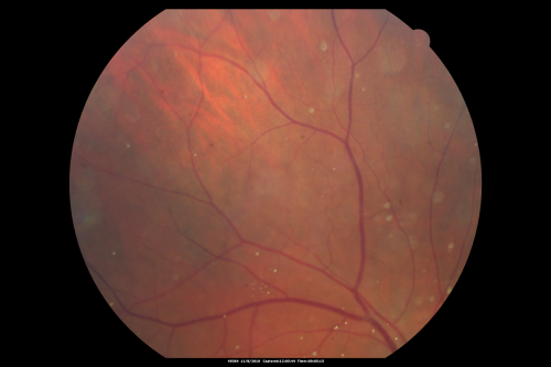 Psuedo-retinitis Pigmentosa - Bone Spicules One Eye - Probably Acute Zonal Occult Outer Retinopathy (AZOOR)
65-year-old woman has pseudoretinitis pigmentosa in the right eye only, most likely from acute zonal occult outer retinopathy.   OD 20/25,  OS 20/25
