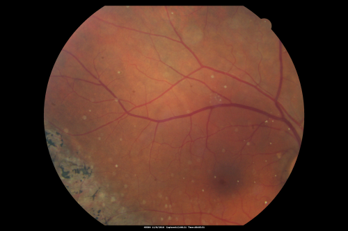 Psuedo-retinitis Pigmentosa - Bone Spicules One Eye - Probably Acute Zonal Occult Outer Retinopathy (AZOOR)
65-year-old woman has pseudoretinitis pigmentosa in the right eye only, most likely from acute zonal occult outer retinopathy.   OD 20/25,  OS 20/25
