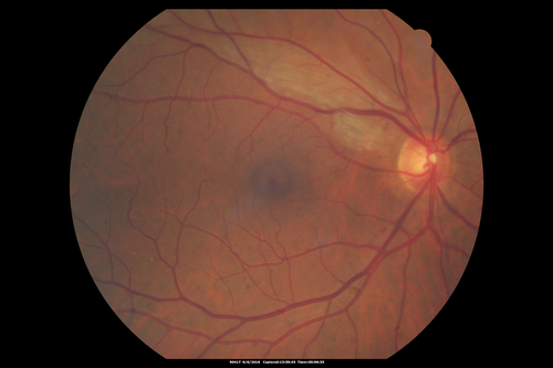 Bilateral Branch Retinal Artery Occlusion - Intraarterial (hollenhorst) plaques visible
67 year old with acute visual field loss in each eye.  Vision is 20/25 right eye 20/32 left eye.  Images show intra-arterial plaques in each eye.  The right eye on the optic nerve and the left eye in a branch retinal artery.
