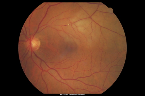 Bilateral Branch Retinal Artery Occlusion - Intraarterial (hollenhorst) plaques visible
67 year old with acute visual field loss in each eye.  Vision is 20/25 right eye 20/32 left eye.  Images show intra-arterial plaques in each eye.  The right eye on the optic nerve and the left eye in a branch retinal artery.
