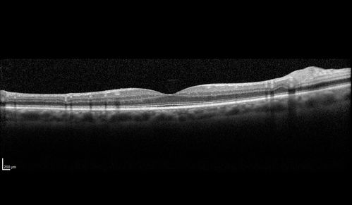 Bilateral Branch Retinal Artery Occlusion - Intraarterial (hollenhorst) plaques visible
67 year old with acute visual field loss in each eye.  Vision is 20/25 right eye 20/32 left eye.  Images show intra-arterial plaques in each eye.  The right eye on the optic nerve and the left eye in a branch retinal artery.
