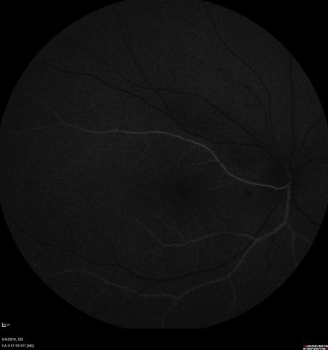 Bilateral Branch Retinal Artery Occlusion - Intraarterial (hollenhorst) plaques visible
67 year old with acute visual field loss in each eye.  Vision is 20/25 right eye 20/32 left eye.  Images show intra-arterial plaques in each eye.  The right eye on the optic nerve and the left eye in a branch retinal artery.
