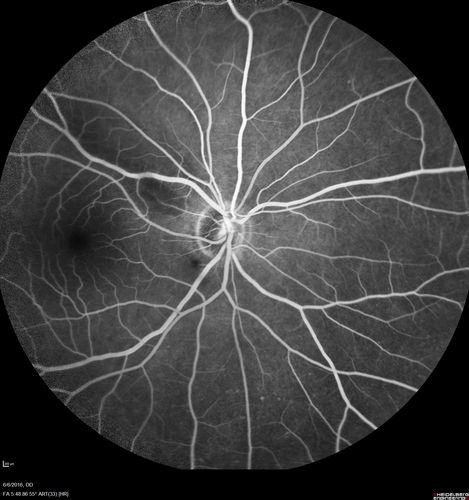 Bilateral Branch Retinal Artery Occlusion - Intraarterial (hollenhorst) plaques visible
67 year old with acute visual field loss in each eye.  Vision is 20/25 right eye 20/32 left eye.  Images show intra-arterial plaques in each eye.  The right eye on the optic nerve and the left eye in a branch retinal artery.
