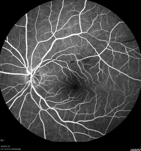 Bilateral Branch Retinal Artery Occlusion - Intraarterial (hollenhorst) plaques visible
67 year old with acute visual field loss in each eye.  Vision is 20/25 right eye 20/32 left eye.  Images show intra-arterial plaques in each eye.  The right eye on the optic nerve and the left eye in a branch retinal artery.
