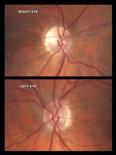 Sectoral Optic Atrophy from an old Branch Retinal Artery Occlusion 
74-year-old woman had cataract surgery 3 months ago.  Her vision in the right eye has been abnormal since.  She notices a shadow in the inferior vision in the right eye.    OD is 20/60, OS is 20/50
