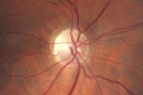 Sectoral Optic Atrophy from an old Branch Retinal Artery Occlusion 
74-year-old woman had cataract surgery 3 months ago.  Her vision in the right eye has been abnormal since.  She notices a shadow in the inferior vision in the right eye.    OD is 20/60, OS is 20/50
