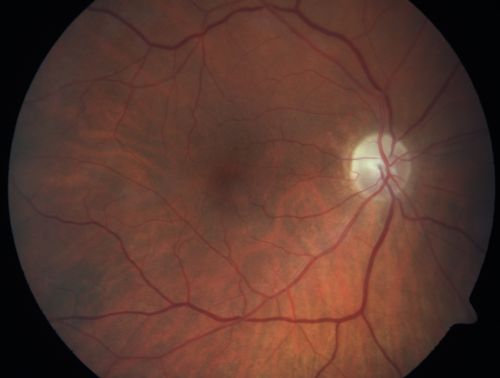 Sectoral Optic Atrophy from an old Branch Retinal Artery Occlusion 
74-year-old woman had cataract surgery 3 months ago.  Her vision in the right eye has been abnormal since.  She notices a shadow in the inferior vision in the right eye.    OD is 20/60, OS is 20/50
