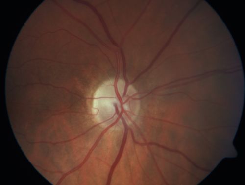 Sectoral Optic Atrophy from an old Branch Retinal Artery Occlusion 
74-year-old woman had cataract surgery 3 months ago.  Her vision in the right eye has been abnormal since.  She notices a shadow in the inferior vision in the right eye.    OD is 20/60, OS is 20/50
