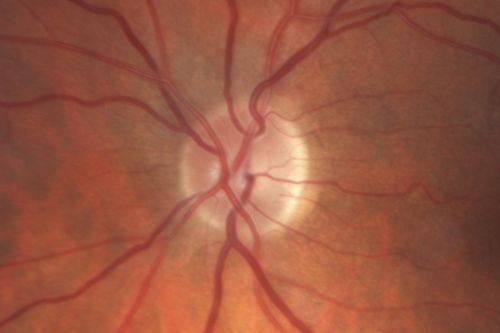 Sectoral Optic Atrophy from an old Branch Retinal Artery Occlusion 
74-year-old woman had cataract surgery 3 months ago.  Her vision in the right eye has been abnormal since.  She notices a shadow in the inferior vision in the right eye.    OD is 20/60, OS is 20/50
