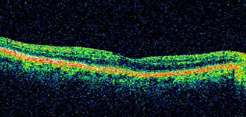 Sectoral Optic Atrophy from an old Branch Retinal Artery Occlusion 
74-year-old woman had cataract surgery 3 months ago.  Her vision in the right eye has been abnormal since.  She notices a shadow in the inferior vision in the right eye.    OD is 20/60, OS is 20/50
