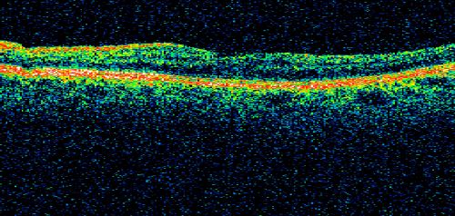 Sectoral Optic Atrophy from an old Branch Retinal Artery Occlusion 
74-year-old woman had cataract surgery 3 months ago.  Her vision in the right eye has been abnormal since.  She notices a shadow in the inferior vision in the right eye.    OD is 20/60, OS is 20/50
