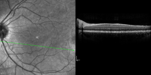 Basal Laminar Drusen - Cuticular Drusen - 19 Year Old with Lupus Nephritis
19-year-old.  She has a history of developing severe systemic lupus erythematosus in 2001.  She was in renal failure and had biopsy proven Class 2 lupus nephritis.  She is currently on Plaquenil 400 mg for six years, as well as Prednisolone orally, every other day. OD 20/20, OS 20/25.
