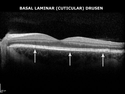 Basal Laminar Drusen - Cuticular Drusen - 19 Year Old with Lupus Nephritis
19-year-old.  She has a history of developing severe systemic lupus erythematosus in 2001.  She was in renal failure and had biopsy proven Class 2 lupus nephritis.  She is currently on Plaquenil 400 mg for six years, as well as Prednisolone orally, every other day. OD 20/20, OS 20/25.
