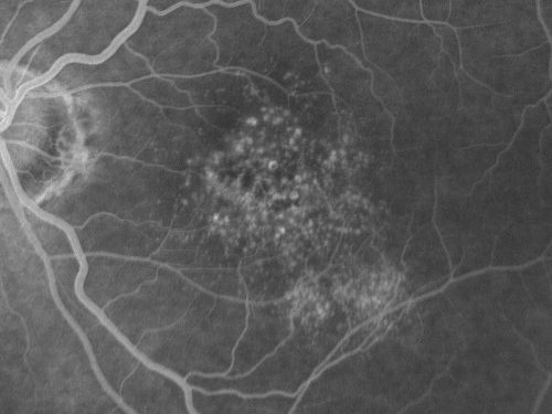 Basal Laminar (cuticular) Drusen both eyes 60 Year Old Woman
60-year-old woman with minimal vision loss.  Vision OD is 20/30 OS 20/40
