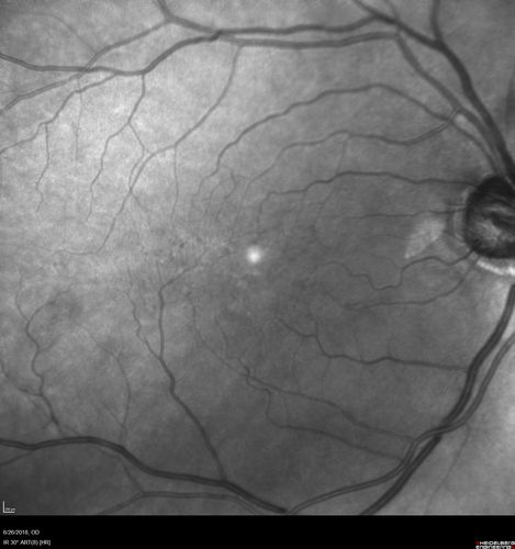 Diabetic Macular Ischemia - Enlarged FAZ - OCT-A
70 year old female diagnosed with diabetes 2 years ago.  Her blood pressure was normal at 116/73.  She has vision loss for 6 months in both eyes.  VA is 20/100 OU.  OCT-A shows macular ischemia.
