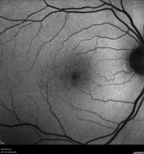 Diabetic Macular Ischemia - Enlarged FAZ - OCT-A
70 year old female diagnosed with diabetes 2 years ago.  Her blood pressure was normal at 116/73.  She has vision loss for 6 months in both eyes.  VA is 20/100 OU.  OCT-A shows macular ischemia.
