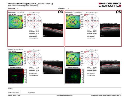 Diabetic Macular Ischemia - Enlarged FAZ - OCT-A
70 year old female diagnosed with diabetes 2 years ago.  Her blood pressure was normal at 116/73.  She has vision loss for 6 months in both eyes.  VA is 20/100 OU.  OCT-A shows macular ischemia.
