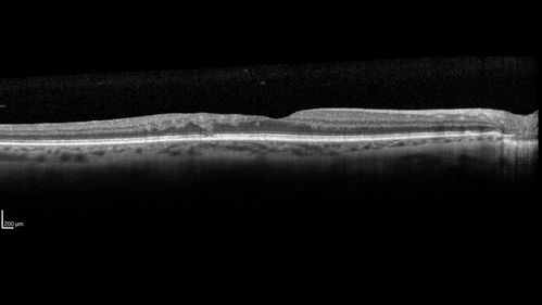 Diabetic Macular Ischemia - Enlarged FAZ - OCT-A
70 year old female diagnosed with diabetes 2 years ago.  Her blood pressure was normal at 116/73.  She has vision loss for 6 months in both eyes.  VA is 20/100 OU.  OCT-A shows macular ischemia.
