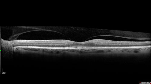 Diabetic Macular Ischemia - Enlarged FAZ - OCT-A
70 year old female diagnosed with diabetes 2 years ago.  Her blood pressure was normal at 116/73.  She has vision loss for 6 months in both eyes.  VA is 20/100 OU.  OCT-A shows macular ischemia.
