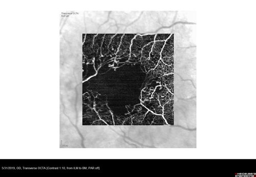 Diabetic Macular Ischemia - Enlarged FAZ - OCT-A
70 year old female diagnosed with diabetes 2 years ago.  Her blood pressure was normal at 116/73.  She has vision loss for 6 months in both eyes.  VA is 20/100 OU.  OCT-A shows macular ischemia.
