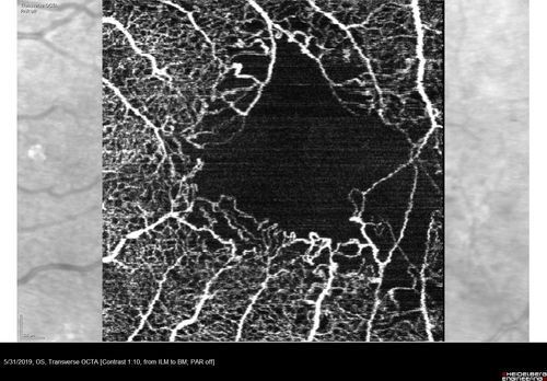 Diabetic Macular Ischemia - Enlarged FAZ - OCT-A
70 year old female diagnosed with diabetes 2 years ago.  Her blood pressure was normal at 116/73.  She has vision loss for 6 months in both eyes.  VA is 20/100 OU.  OCT-A shows macular ischemia.

