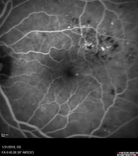 bdr_edema_laser_redas_013119_13.jpg