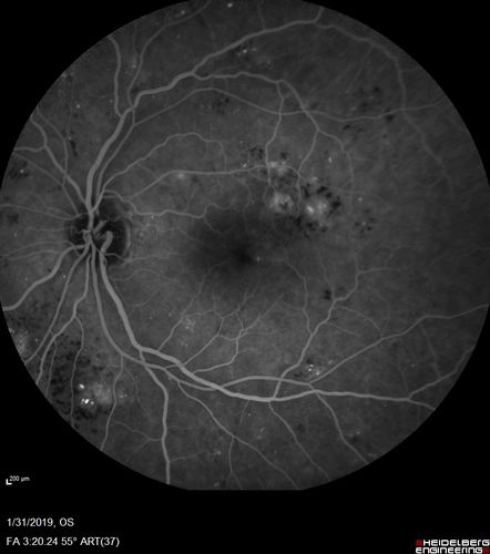 bdr_edema_laser_redas_013119_15.jpg