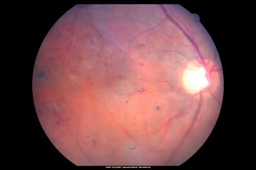 Diabetic and Pseudophakic Cystoid Macular Edema Pretreatment Fundus Photo
56-year-old woman has diabetic retinopathy in both eyes and macular edema.  She is recently pseudophakic.  OD 20/80, OS 20/200.  
Keywords: cme;bdr;pseudophakic;laser;kenalog