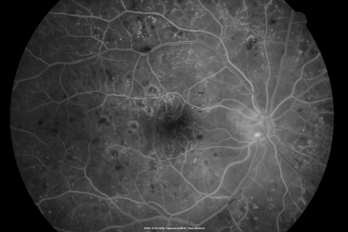 Diabetic and Pseudophakic Cystoid Macular Edema Pretreatment early FA
56-year-old woman has diabetic retinopathy in both eyes and macular edema.  She is recently pseudophakic.  OD 20/80, OS 20/200.  
Keywords: cme;bdr;pseudophakic;laser;kenalog