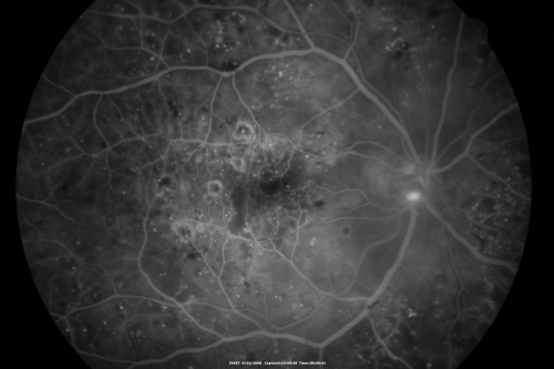 Diabetic and Pseudophakic Cystoid Macular Edema Pretreatment Mid FA
56-year-old woman has diabetic retinopathy in both eyes and macular edema.  She is recently pseudophakic.  OD 20/80, OS 20/200.  
Keywords: cme;bdr;pseudophakic;laser;kenalog