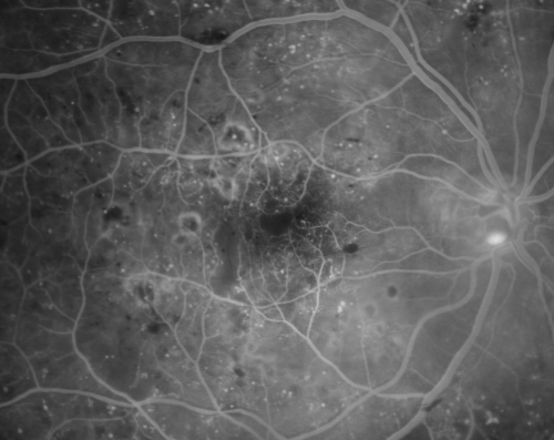 Diabetic and Pseudophakic Cystoid Macular Edema Pretreatment Mid FA
56-year-old woman has diabetic retinopathy in both eyes and macular edema.  She is recently pseudophakic.  OD 20/80, OS 20/200.  
Keywords: cme;bdr;pseudophakic;laser;kenalog